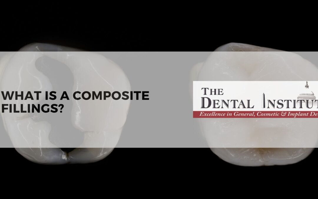 What is a composite filling