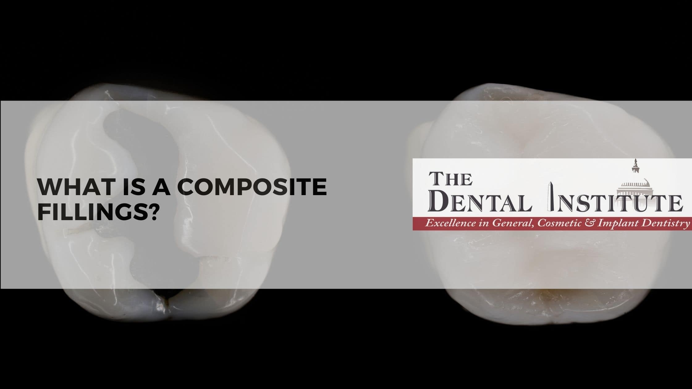What is a composite filling